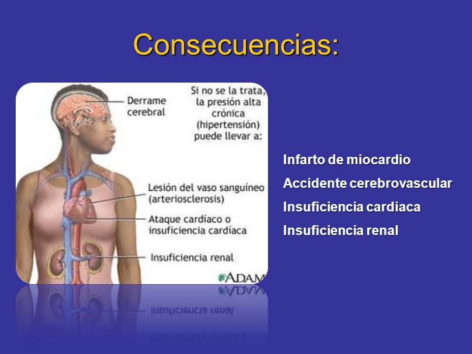 Q consecuencias trae la presion alta